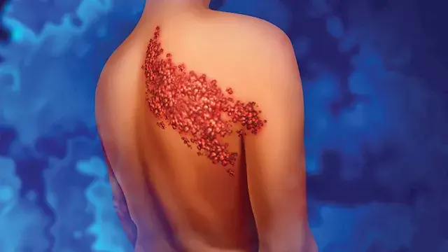 أعراض الحزام الناري وتأثيره على الأعصاب